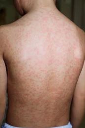 First case of measles reported in southern Illinois; second case confirmed in Kentucky