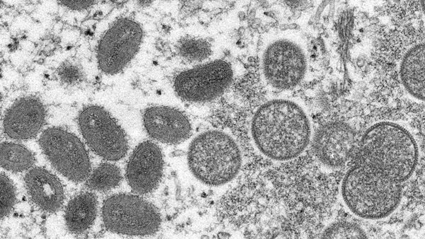 First probable case of monkeypox identified in Kentucky